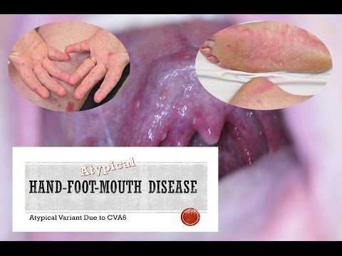how to relieve pain from hfmd