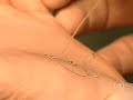 Aneurisma Cerebral Aneurisma Cerebral