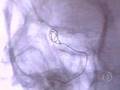 Aneurisma Cerebral