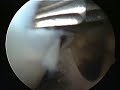 Osteochondral Cartilage (sample) - www.proceduresconsult.com