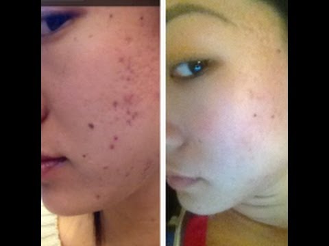 how to banish acne scars