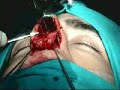 Vesalius Project. Rinoplastia Abierta. Dr. Agustin Blanch