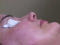 PLASTIC SURGERY UPDATE:  PIXEL MICROFRACTIONATED LASER