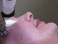 PLASTIC SURGERY UPDATE: PIXEL MICROFRACTIONATED LASER