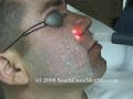 Laser Acne Scar Removal - Male Hispanic Patient