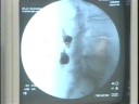 xStop Spinal Procedure