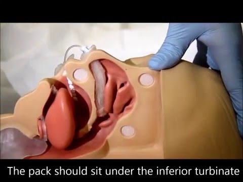 how to treat epistaxis