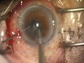 IFIS, cataract surgery 白内障手術(2)