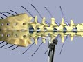 X-Stop Procedure Animated X-Stop Procedure Animated