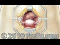 on.fb.me -NEW facebook page - it's cool! Patient Education - Patient Education Company Your doctor has recommended that you have a hysterectomy with the removal of the ovaries and fallopian tubes. But what does that actually mean? Hysterectomy is the removal of the uterus - the organ that holds and protects the fetus during pregnancy. Hysterectomy often also involves the removal of other parts of the reproductive system, including the ovaries - where eggs are produced - the fallopian tubes which carry the eggs to the uterus and the cervix - or neck of the uterus. There are many different reasons why a doctor may recommend this kind of surgery. Patient Education In many cases, disease or the growth of abnormal tissue will lead a doctor to recommend the removal of the uterus, the ovaries and fallopian tubes. In some cases, unusually heavy menstrual flow and the accompanying discomfort may make hysterectomy an important treatment option for patient and physician to consider. But no matter what the reason behind it, you should be aware that the removal of the uterus and other reproductive organs is a serious step and it can mean significant changes in your life. Patient Education After having a hysterectomy, you will not be able to have children and if because your ovaries are removed as part of the procedure, you may even need to take medication to replace hormones that your body once produced on its own. So make sure that you ask your doctor to carefully explain the reasons <b>...</b>
