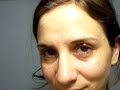 Orzuelo / Stye