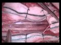 Spinal Meningioma Surgical Removal