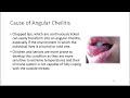 Home Treatment for Angular Cheilitis Healing