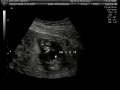 It's a Girl!.wmv