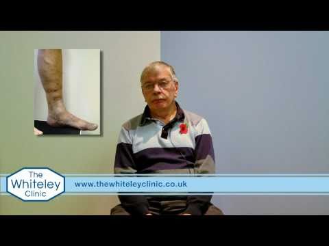 how to treat varicose eczema