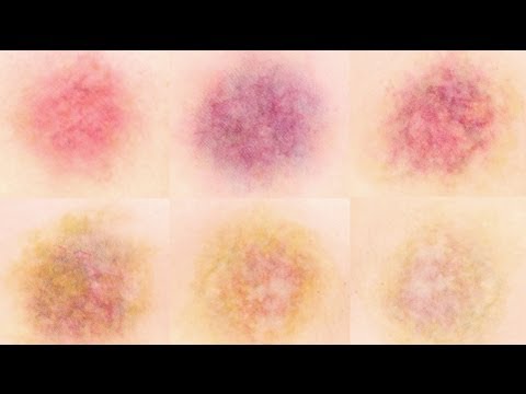 bruises - Hey guys! Today I'm tackling bruises and the various stages as they heal. In this tutorial I demonstrate five different bruises. General info to keep in mind...