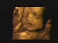 Triplet 3d ultrasound