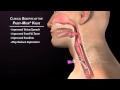 Clinical Benefits of the Passy-Muir Valve