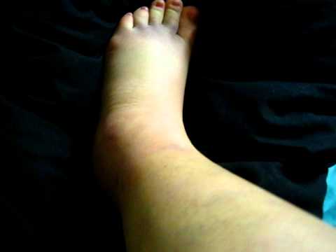 how to measure pitting edema