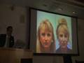 PLASTIC SURGERY - LECTURE ON RESTYLANE PERLANE RADIESSE