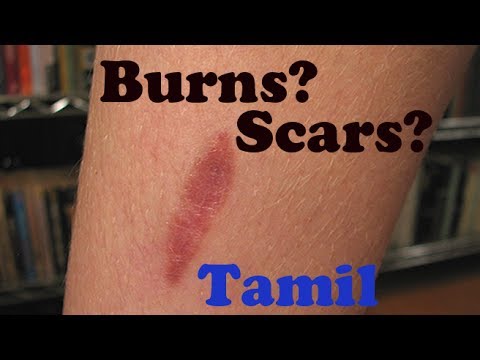 how to treat scars from a burn