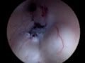 ENDOSCOPIC 3RD VENTRICULOSTOMY AND VENTRICULAR EXPLORATION