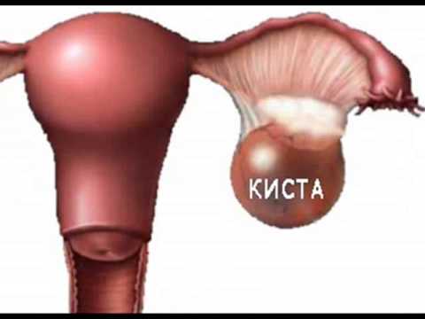 Киста левого яичника 3 см что делать