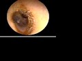 Punctured Ear Drum Gross