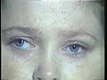 Upbeat Nystagmus