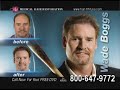 Hair loss surgery