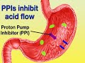 Treating GERD (GERD #3)