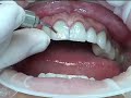 Dr. David Hornbrook: Laser Removal of Veneers Dr. David Hornbrook: Laser Removal of Veneers