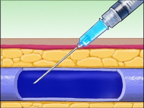 how to self iv injection