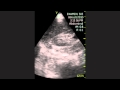 Extrarenal Pelvis
