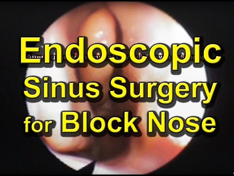 how to relieve maxillary sinus pain