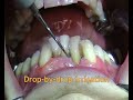 Instructional video on Satelec H3 tip by ACTEON
