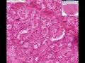 Histopathology Thyroid--Graves Disease