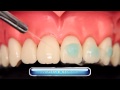 Natural Ortho Nova DFL