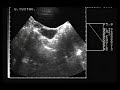 MEGAURETER DYNAMIC ULTRASOUND (YO-YO EFFECT)