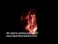3D ultrasound of IUD in uterus 3D ultrasound of IUD in uterus