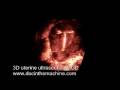 3D ultrasound of IUD in uterus