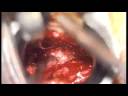 Microdiscectomy L4/L5