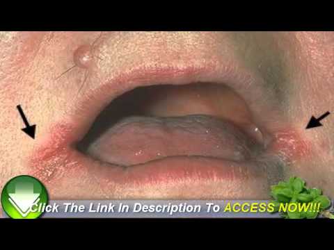 how to cure cuts on side of mouth