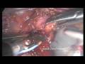 Laparoscopic Excision Of Uterus And Ovaries - Part 3 Of 4