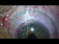 Epi-LASIK Philadelphia: Advanced Surface Ablation in HD Epi-LASIK Philadelphia: Advanced Surface Ablation in HD