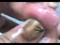 cortadas