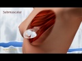 www.clinicadual.es Operación o intervención de aumento de mamas / pechos / senos. Implante prótesis en 3D. (en Alta Definición HD)