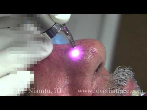 how to treat spider veins