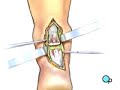 PreOp® Patient Education: Achilles Tendon Repair Surgery