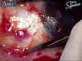 Pterygium